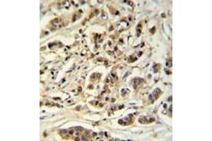 Immunohistochemistry analysis in formalin fixed and paraffin embedded breast carcinoma reacted with METT11D1 Antibody (N-term) followed which was followed by peroxidase conjugated to the secondary antibody and followed by DAB staining. (METTL17 抗体  (N-Term))