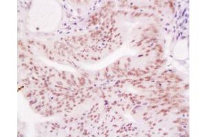 Formalin-fixed and paraffin embedded human endometrium tissue labeled with Anti-MLH-1 Polyclonal Antibody, Unconjugated  at 1:200, followed by conjugation to the secondary antibody and DAB staining (MLH1 抗体  (AA 501-600))
