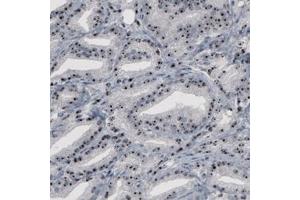 Immunohistochemical staining (Formalin-fixed paraffin-embedded sections) of human prostate cancer with NOP56 monoclonal antibody, clone CL2603  shows strong nucleolar positivity in glandular cells.