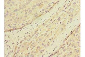 Immunohistochemistry of paraffin-embedded human liver cancer using ABIN7165883 at dilution of 1:100 (POMGNT1 抗体  (AA 59-300))