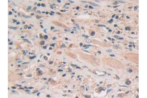 DAB staining on IHC-P; Samples: Human Prostate cancer Tissue (GSAP 抗体  (AA 616-854))