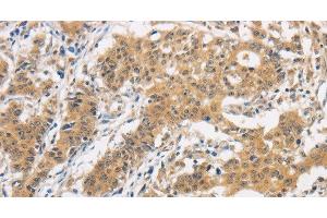 Immunohistochemistry of paraffin-embedded Human gasrtic cancer tissue using ITGB3BP Polyclonal Antibody at dilution 1:50 (ITGB3BP 抗体)