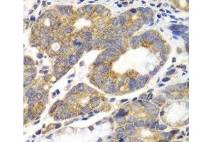 Immunohistochemistry of paraffin-embedded Human gastric cancer using PFKM Polyclonal Antibody at dilution of 1:100 (40x lens). (PFKM 抗体)