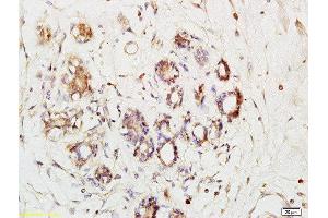 Formalin-fixed and paraffin embedded human breast cancer labeled with Anti-Phospho-Ack1(Tyr284)Polyclonal Antibody, Unconjugated  at 1:200 followed by conjugation to the secondary antibody and DAB staining (TNK2 抗体  (pTyr284))
