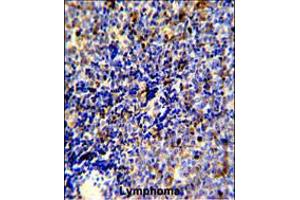 Formalin-fixed and paraffin-embedded human lymphoma reacted with MERTK Antibody, which was peroxidase-conjugated to the secondary antibody, followed by DAB staining. (MERTK 抗体)