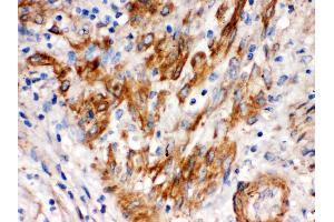 SFRP4 was detected in paraffin-embedded sections of human endometrial carcinoma tissues using rabbit anti SFRP4 Antigen Affinity purified polyclonal antibody at 1 μg/mL. (SFRP4 抗体  (AA 22-303))