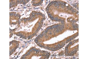 Immunohistochemistry of Human liver cancer using HRG Polyclonal Antibody at dilution of 1:50 (HRG 抗体)
