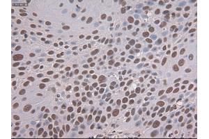 Immunohistochemical staining of paraffin-embedded Adenocarcinoma of colon tissue using anti-NOTCH1mouse monoclonal antibody. (Notch1 抗体  (AA 2300-2556))