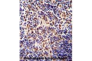 TIGD3 antibody (C-term) immunohistochemistry analysis in formalin fixed and paraffin embedded human hodgkin lymphoma followed by peroxidase conjugation of the secondary antibody and DAB staining. (TIGD3 抗体  (C-Term))