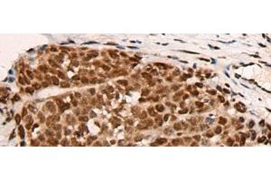 Immunohistochemistry of paraffin-embedded Human thyroid cancer tissue using HGH1 Polyclonal Antibody at dilution of 1:45(x200) (FAM203B 抗体)