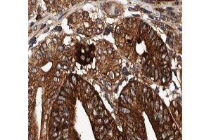 ABIN6266876 at 1/100 staining human Stomach cancer tissue sections by IHC-P. (COX19 抗体  (N-Term))