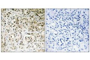 Immunohistochemistry analysis of paraffin-embedded human liver carcinoma tissue using TAF5 antibody. (TAF5 抗体  (Internal Region))