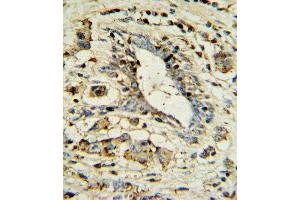 APOL1 Antibody IHC analysis in formalin fixed and paraffin embedded human breast carcinoma followed by peroxidase conjugation of the secondary antibody and DAB staining. (APOL1 抗体  (AA 137-171))