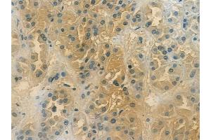 ABIN6258607 and ABIN6273428 at 1/100 staining human renal cell carcinoma by IHC-P.