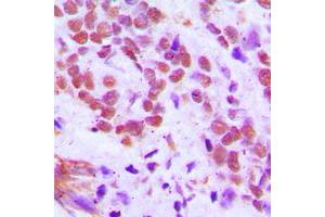 Immunohistochemical analysis of RFX3 staining in human breast cancer formalin fixed paraffin embedded tissue section. (RFX3 抗体  (C-Term))