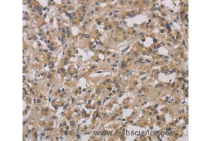 Immunohistochemistry of Human gastric cancer using DCN Polyclonal Antibody at dilution of 1:30 (Decorin 抗体)