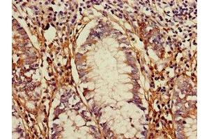 Immunohistochemistry of paraffin-embedded human colon cancer using ABIN7172274 at dilution of 1:100 (TLR5 抗体  (AA 682-850))