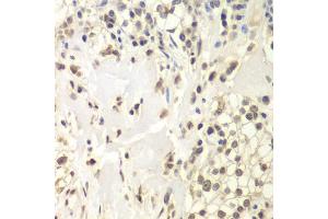 Immunohistochemistry of paraffin-embedded human kidney cancer using USP7/HAUSP antibody (ABIN6132279, ABIN6150031, ABIN6150033 and ABIN6217612) at dilution of 1:200 (40x lens). (USP7 抗体  (AA 206-1102))