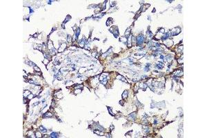 Immunohistochemistry of paraffin-embedded Human lung cancer using MMP16 Polyclonal Antibody at dilution of 1:100 (40x lens). (MMP16 抗体)