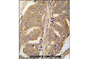 Formalin-fixed and paraffin-embedded human prostata carcinoma tissue reacted with PXN Antibody (Y118) , which was peroxidase-conjugated to the secondary antibody, followed by DAB staining.