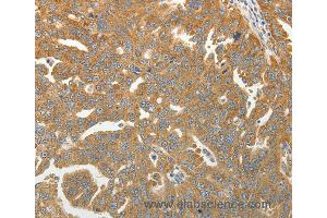 Immunohistochemistry of Human ovarian cancer using RPLP0 Polyclonal Antibody at dilution of 1:40 (RPLP0 抗体)