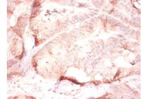 Immunohistochemistry of paraffin-embedded human colon cancer using ABIN7148243 at dilution of 1:50 (COL4a2 抗体  (AA 1493-1712))