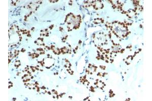 Formalin-fixed, paraffin-embedded human Thyroid stained with PAX8 Recombinant Mouse Monoclonal Antibody (rPAX8/1492). (Recombinant PAX8 抗体  (AA 60-261))