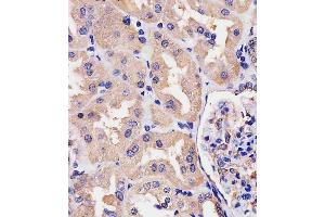 (ABIN390742 and ABIN2841007) staining Villin-1 in human kidney tissue sections by Immunohistochemistry (IHC-P - paraformaldehyde-fixed, paraffin-embedded sections). (Villin 1 抗体  (N-Term))
