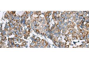 Immunohistochemistry of paraffin-embedded Human liver cancer tissue using PRELID3B Polyclonal Antibody at dilution of 1:90(x200) (SLMO2 抗体)