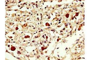 IHC image of ABIN7152301 diluted at 1:300 and staining in paraffin-embedded human melanoma performed on a Leica BondTM system. (EXOSC1 抗体  (AA 587-762))