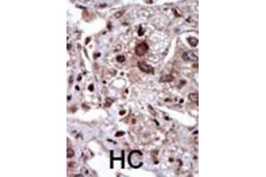 Formalin-fixed and paraffin-embedded human cancer tissue reacted with the primary antibody, which was peroxidase-conjugated to the secondary antibody, followed by DAB staining. (STK39 抗体  (AA 346-376))