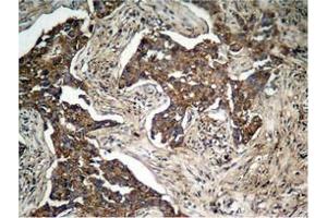 Immunohistochemical analysis of paraffin-embedded human lung carcinoma tissue, using HER2 (Phospho-Tyr1248) Antibody. (ErbB2/Her2 抗体  (pTyr1248))
