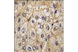 Formalin-fixed and paraffin-embedded human hepatocarcinoma tissue reacted with EphA7 antibody, which was peroxidase-conjugated to the secondary antibody, followed by DAB staining. (EPH Receptor A7 抗体)
