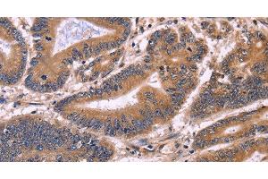 Immunohistochemistry of paraffin-embedded Human colon cancer tissue using S100A13 Polyclonal Antibody at dilution 1:40 (S100A13 抗体)