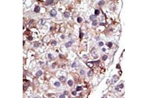 IHC analysis of FFPE human hepatocarcinoma tissue stained with the SPHK2 antibody (SPHK2 抗体  (AA 1-30))