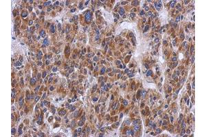 IHC-P Image Immunohistochemical analysis of paraffin-embedded human hepatoma, using PTS, antibody at 1:500 dilution. (PTS 抗体)