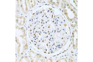 Immunohistochemistry of paraffin-embedded human kidney cancer using CBFB Antibody (ABIN6130041, ABIN6138000, ABIN6138001 and ABIN6220926) at dilution of 1:200 (40x lens). (CBFB 抗体  (AA 1-182))