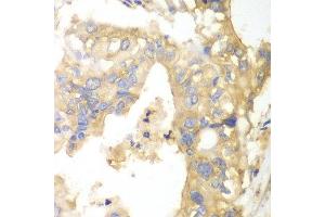 Immunohistochemistry of paraffin-embedded human liver cancer using PYGB antibody at dilution of 1:100 (x40 lens). (PYGB 抗体)