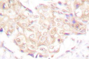 Immunohistochemical analysis of paraffin-embedded human breast cancer tissue using UBR5 polyclonal antibody . (UBR5 抗体)