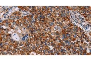 Immunohistochemistry of paraffin-embedded Human lung cancer tissue using ALG2 Polyclonal Antibody at dilution 1:35 (ALG2 抗体)