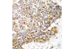 Immunohistochemistry of paraffin-embedded human esophageal cancer using TFAM antibody. (TFAM 抗体)