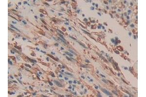 Detection of mTOR in Human Colorectal cancer Tissue using Polyclonal Antibody to Serine/threonine-protein kinase mTOR (mTOR)