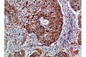 Immunohistochemical analysis of paraffin-embedded human-lung-cancer, antibody was diluted at 1:200