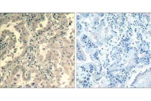 Immunohistochemical analysis of paraffin-embedded human lung carcinoma tissue using stat2 (Ab-690) Antibody (E021536). (STAT2 抗体)