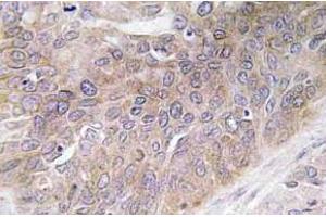 Immunohistochemistry (IHC) analyzes of VEGF-D antibody in paraffin-embedded human lung carcinoma tissue. (VEGFD 抗体)