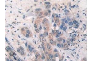 Detection of SOCS2 in Human Breast cancer Tissue using Polyclonal Antibody to Suppressors Of Cytokine Signaling 2 (SOCS2) (SOCS2 抗体  (AA 1-198))