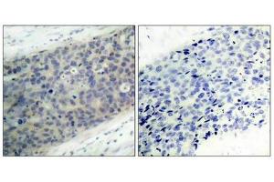 Immunohistochemical analysis of paraffin-embedded human breast carcinoma tissue using LIMK2(Phospho-Thr505) Antibody(left) or the same antibody preincubated with blocking peptide(right). (LIMK2 抗体  (pThr505))