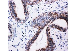IHC-P: PI3K antibody testing of human breast cancer tissue (PIK3R1 抗体  (AA 447-461))