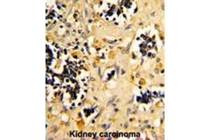 Formalin-fixed and paraffin-embedded human kidney carcinoma reacted with NDUFS4 Antibody (C-term), which was peroxidase-conjugated to the secondary antibody, followed by DAB staining. (NDUFS4 抗体  (C-Term))
