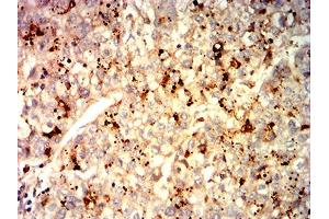 Immunohistochemical analysis of paraffin-embedded liver cancer tissues using GPC3 mouse mAb with DAB staining. (Glypican 3 抗体  (AA 55-200))